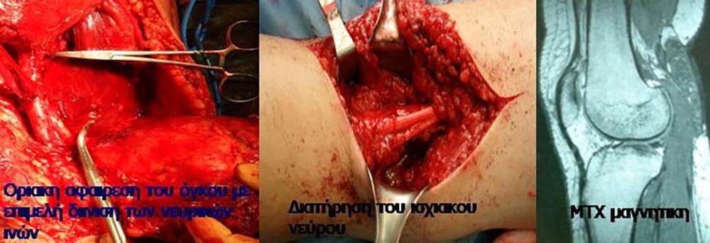 Καλοήθεις Ογκοι Μαλακών Μορίων 7