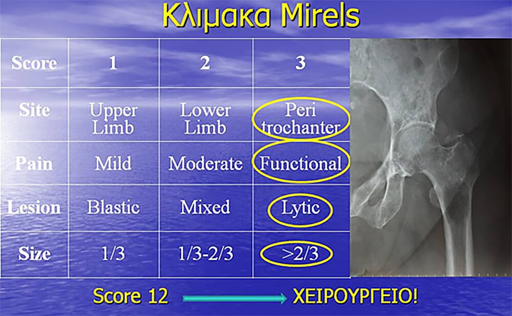 Μεταστατικοί Όγκοι 20