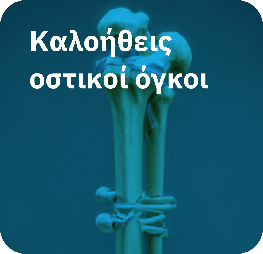 Καλοήθεις οστικοί όγκοι