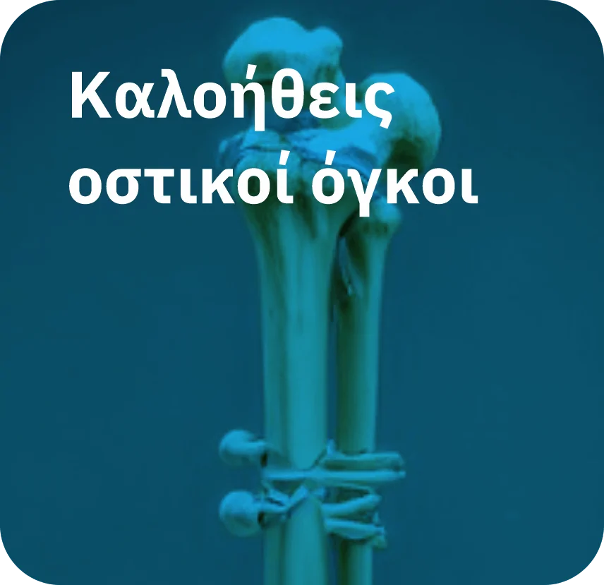 Καλοήθεις οστικοί όγκοι