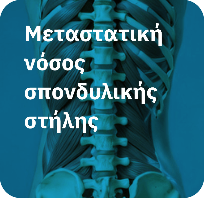 Μεταστατική νόσος σπονδυλικής στήλης