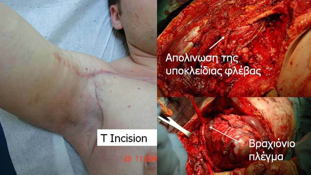 Σαρκώματα Μαλακών Μορίων 9