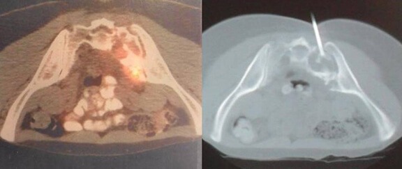 biopsy 2
