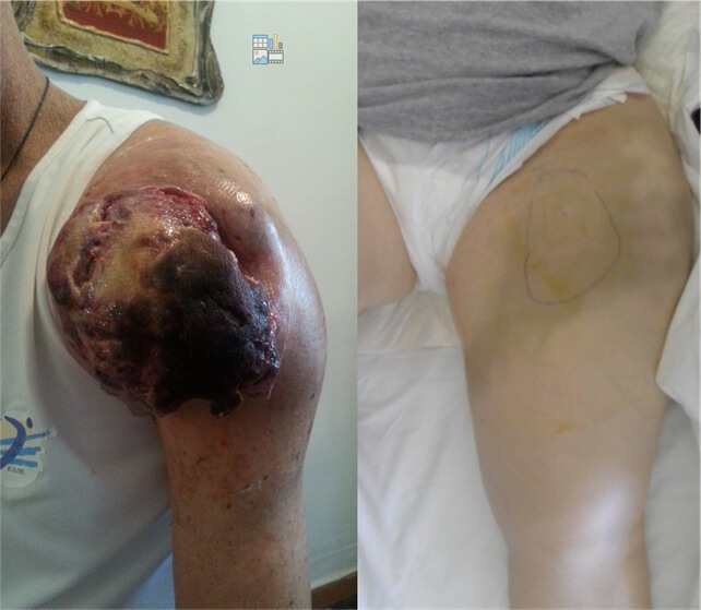 left hand biopsy