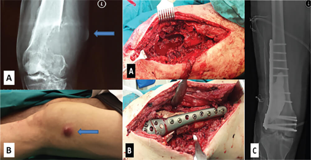 biopsy-plaka-vides-tsimento